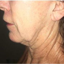 Morpheus8 Before & After Patient #1628